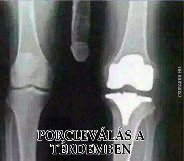 Veszélyes térdsérülés :D pénisz vicces képek röntgen térd